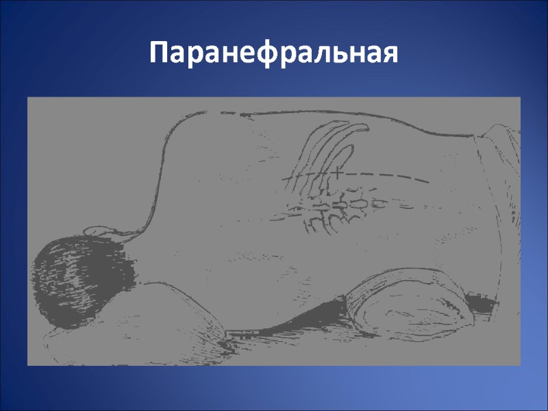 Паранефральная